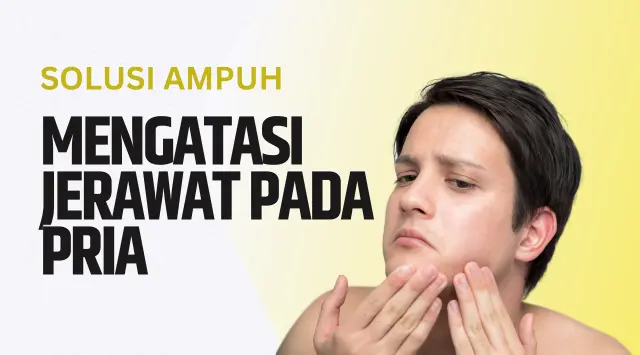 Mengatasi Jerawat pada Pria